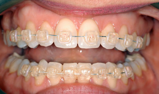 Figure 2: The teeth were correctly aligned in eight weeks