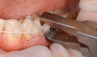 Figure 3: The orthodontic brackets were removed from the molars and second premolars