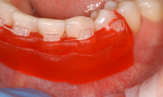 Figure 4: Impressions were taken using red ribbon wax to block out the undercuts