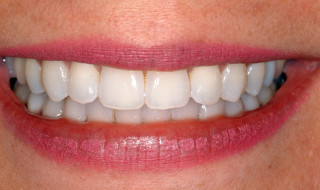 Figure 6: The final smile is natural and stable