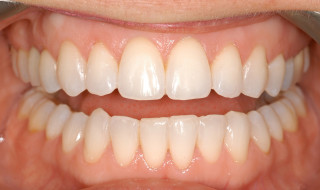 Figure 7: I finished the case with two-week teeth whitening