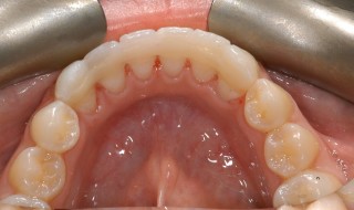 Figure 9: The Solid invisible retainers are kept at least 1.5mm from the incisal edge and from the gum level