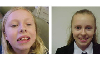 Against the Odds award winner Katharine, pictured before (left) and after (right) orthodontic treatment