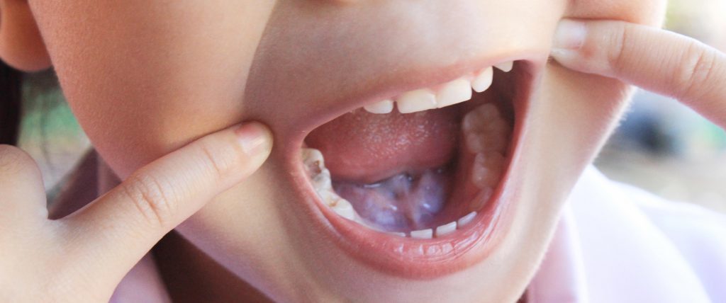 child tooth decay