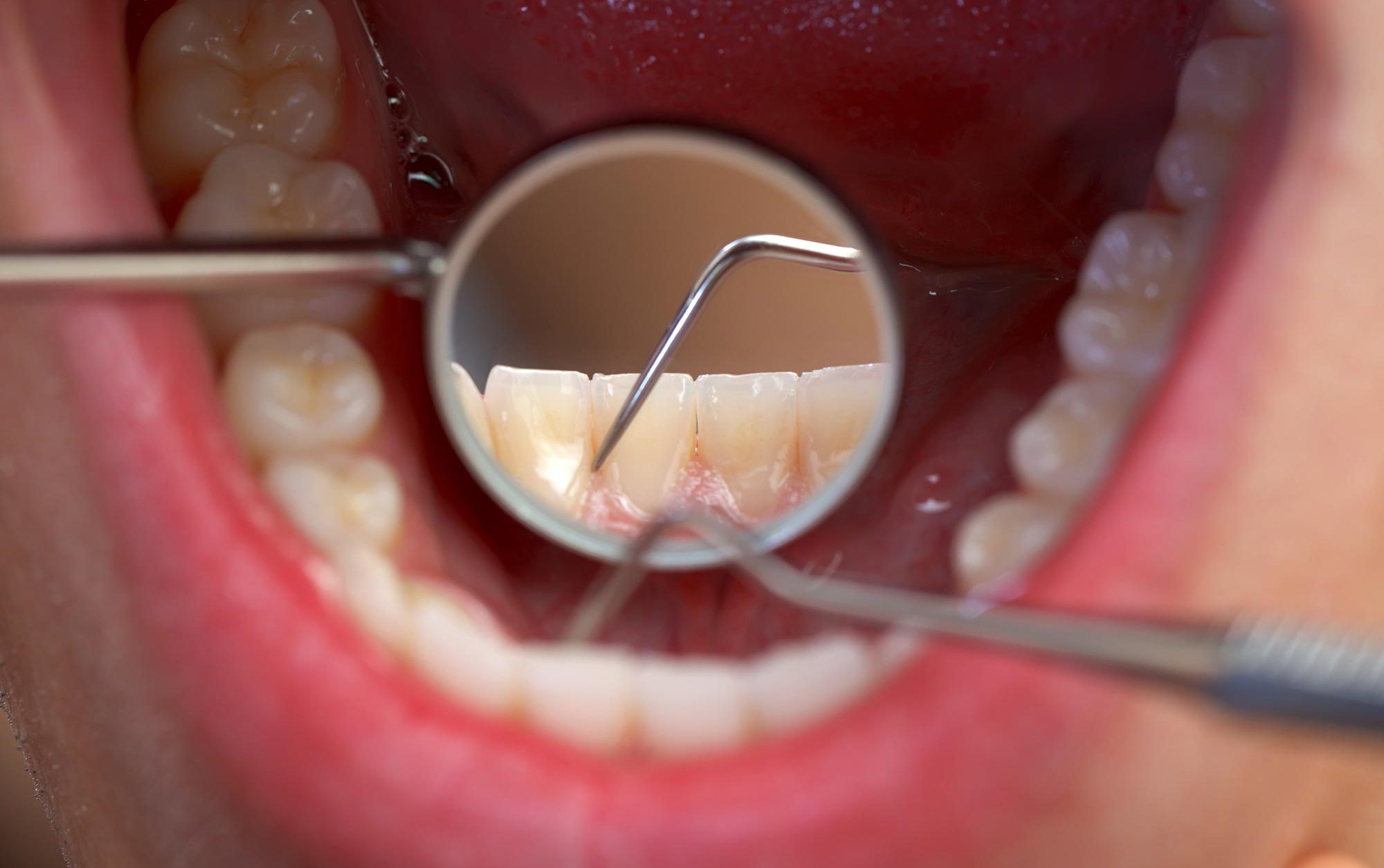 erosive tooth wear third most common oral health disease