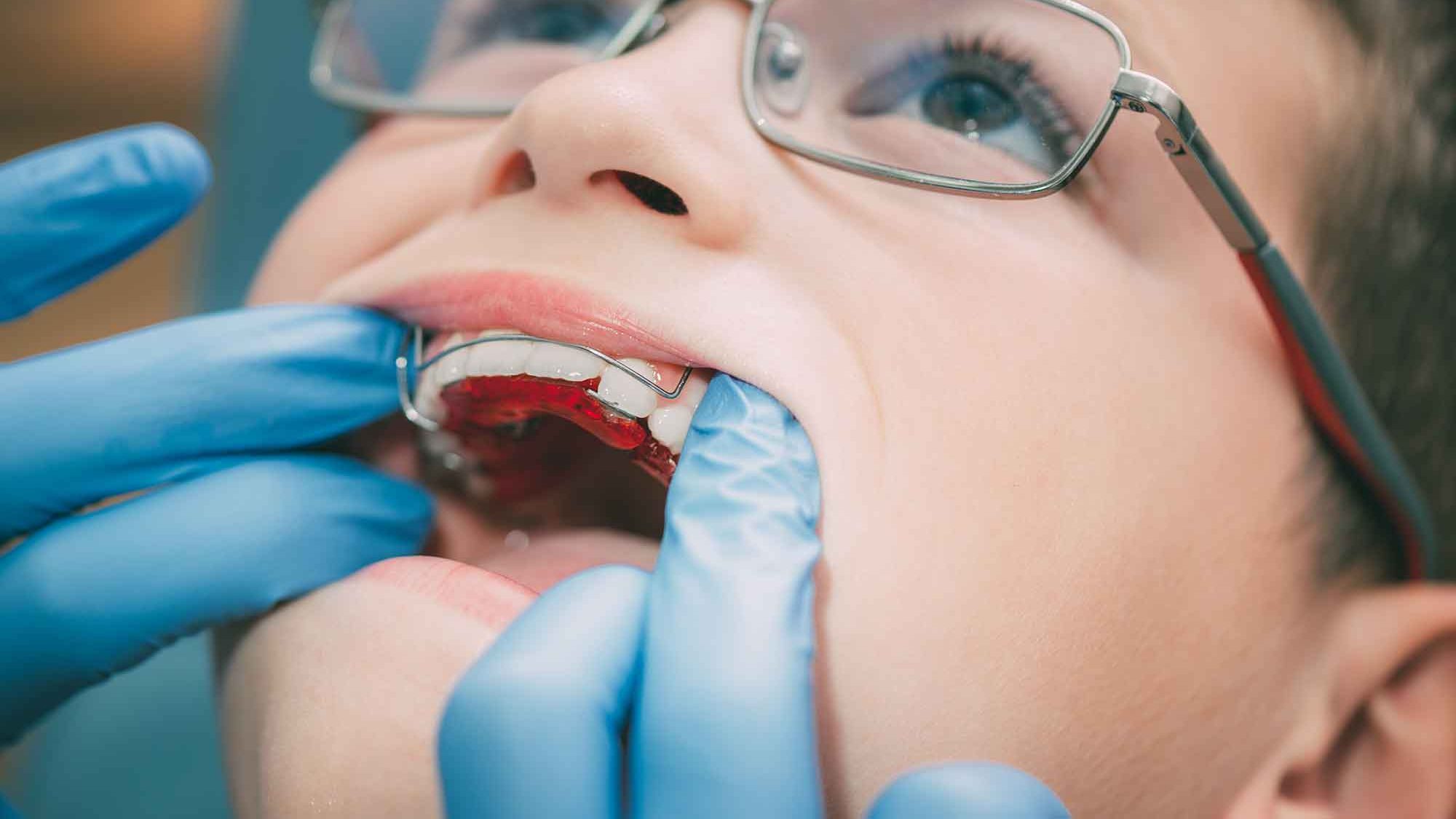 Tendering process for NHS orthodontics is creating a 'race to the bottom', BDA claims
