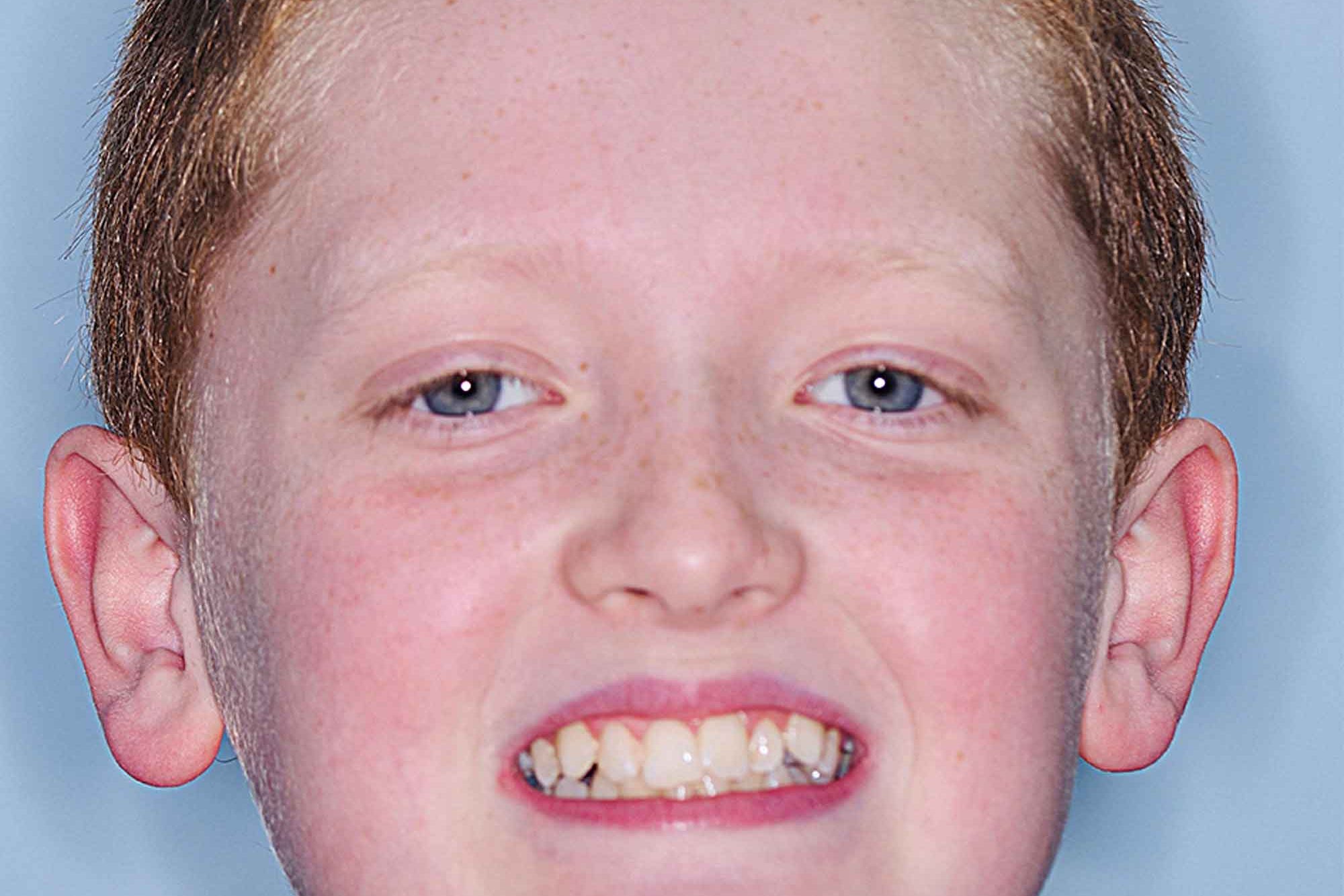 Fig-1-full-face---before