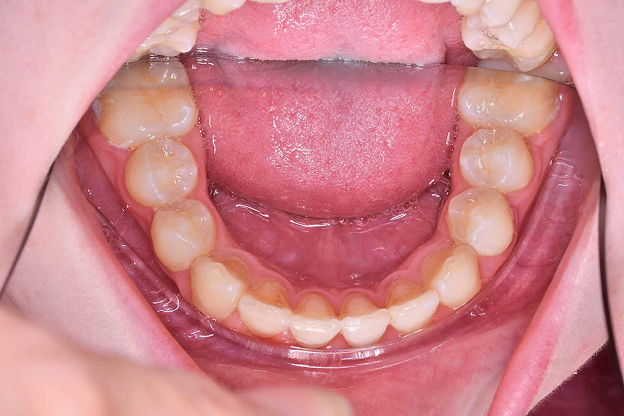 Fig-10-Mandibular-Occlusal---after