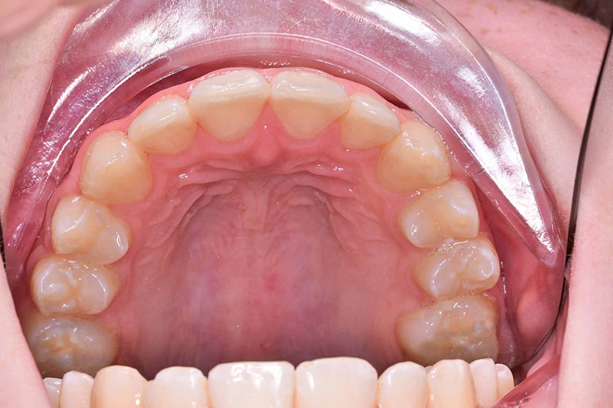 Fig-11-Maxillary-occlusal---after