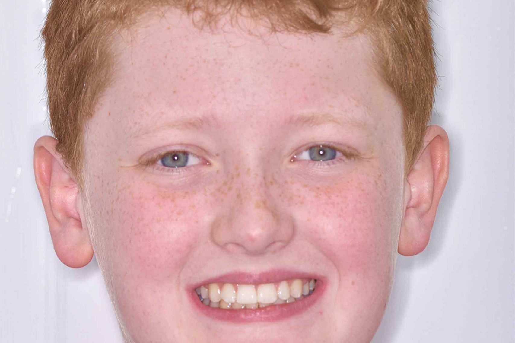 Fig-14-Full-face---after