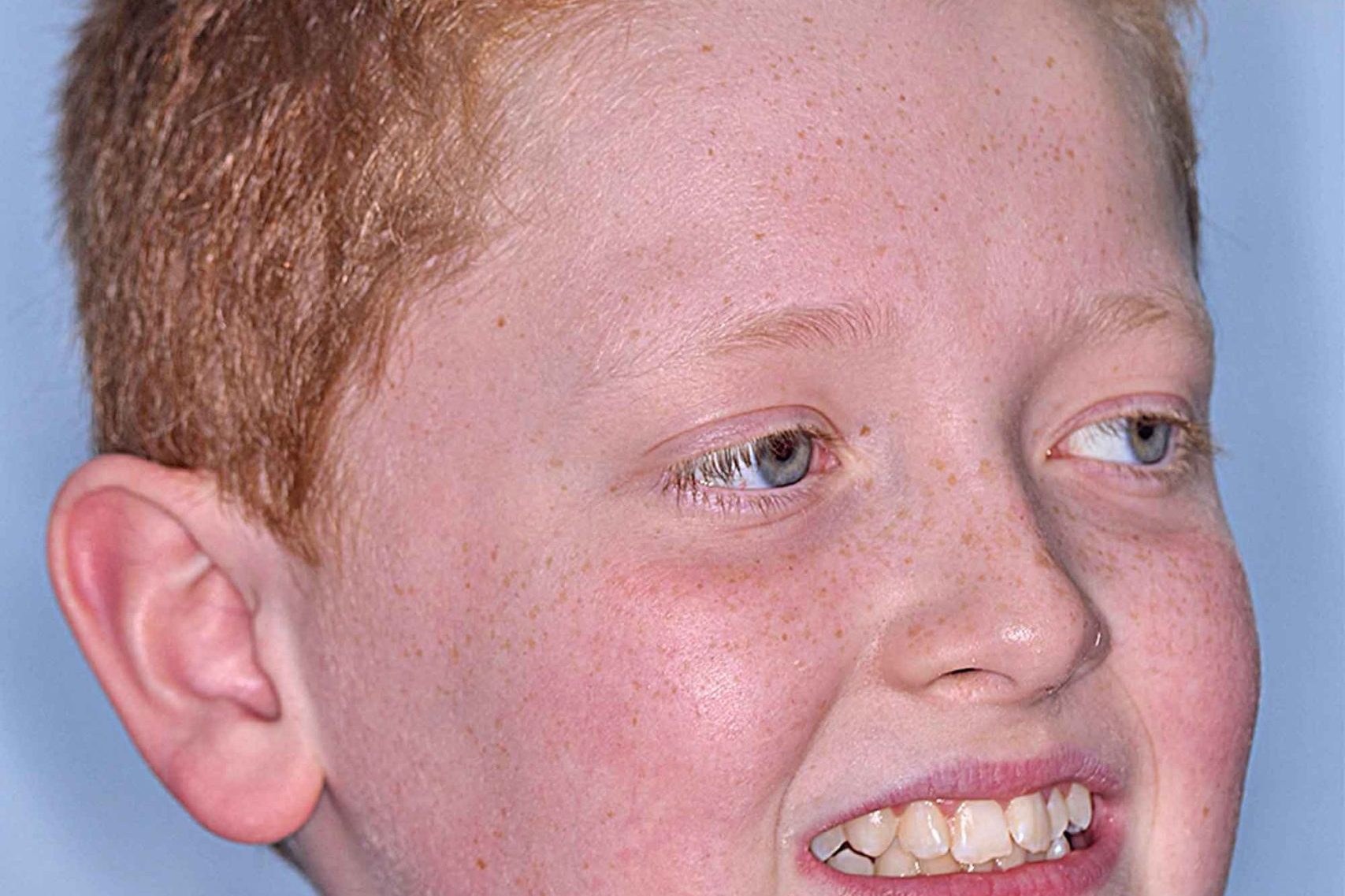 Fig-2-before-face---right-side-view