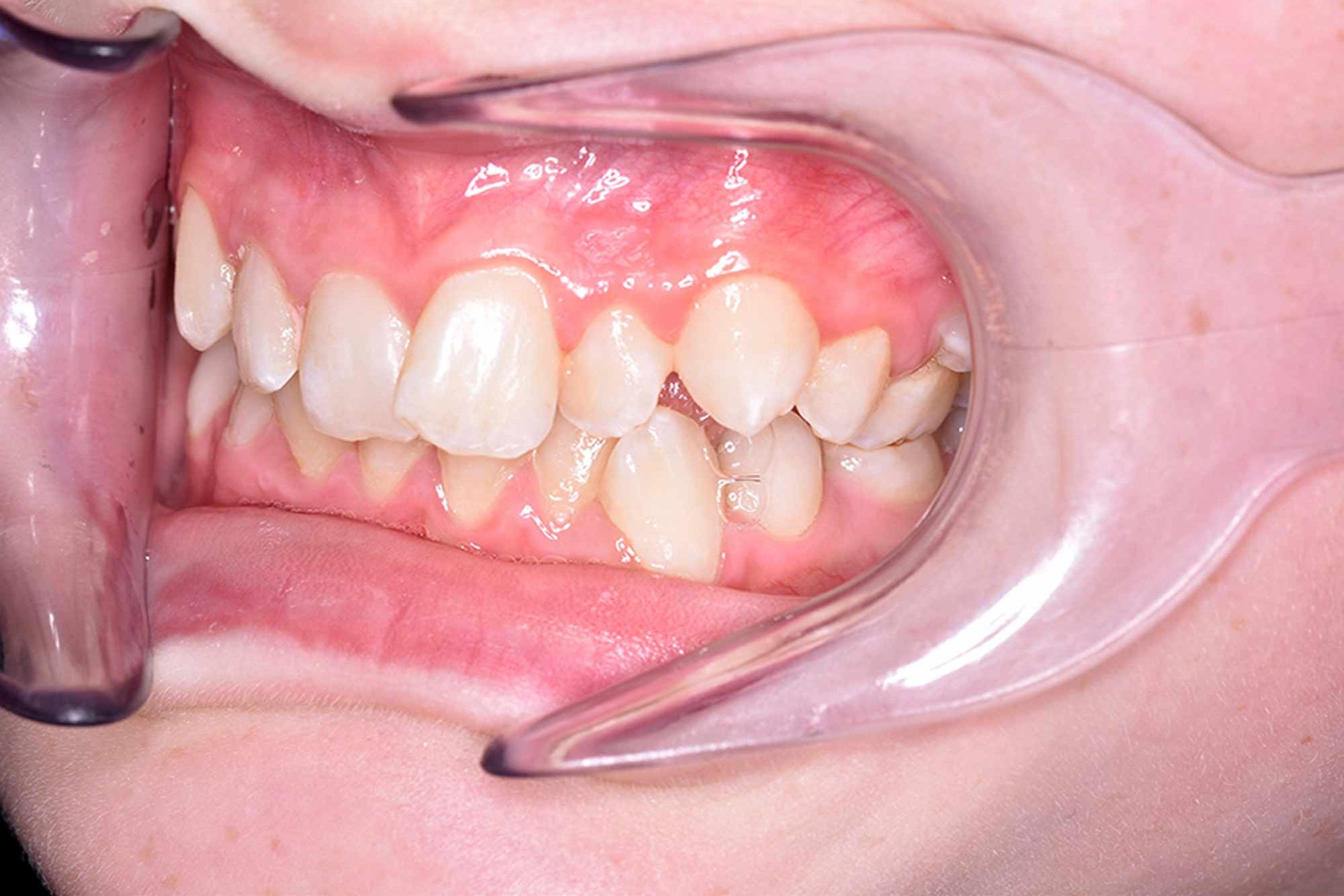 Fig-3-Left-Buccal---before