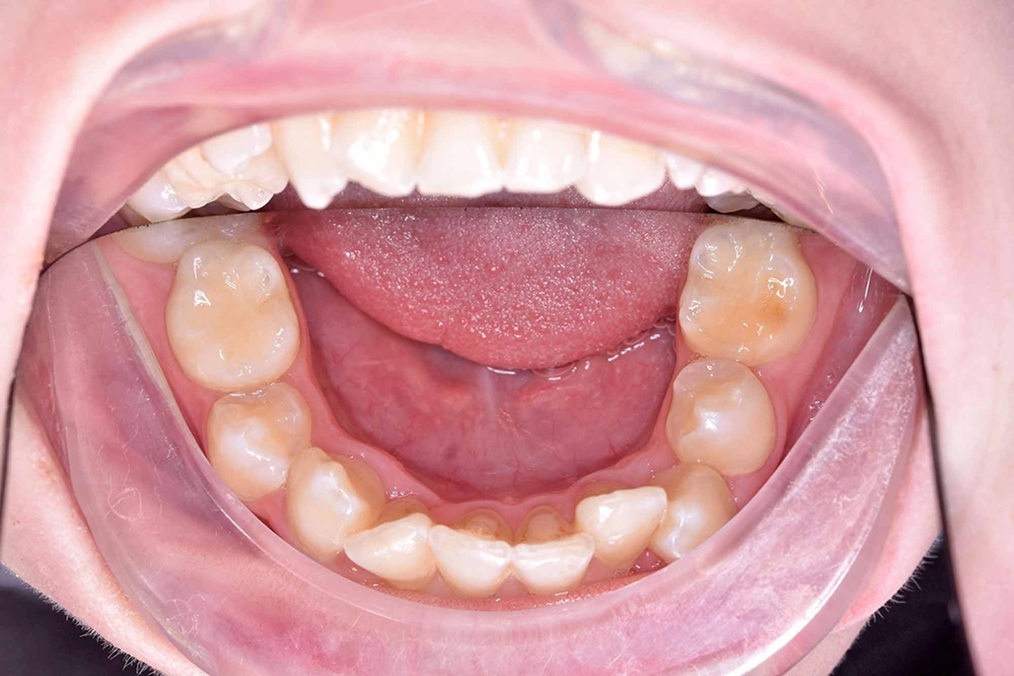 Fig-4-Mandibular-occlusal---before
