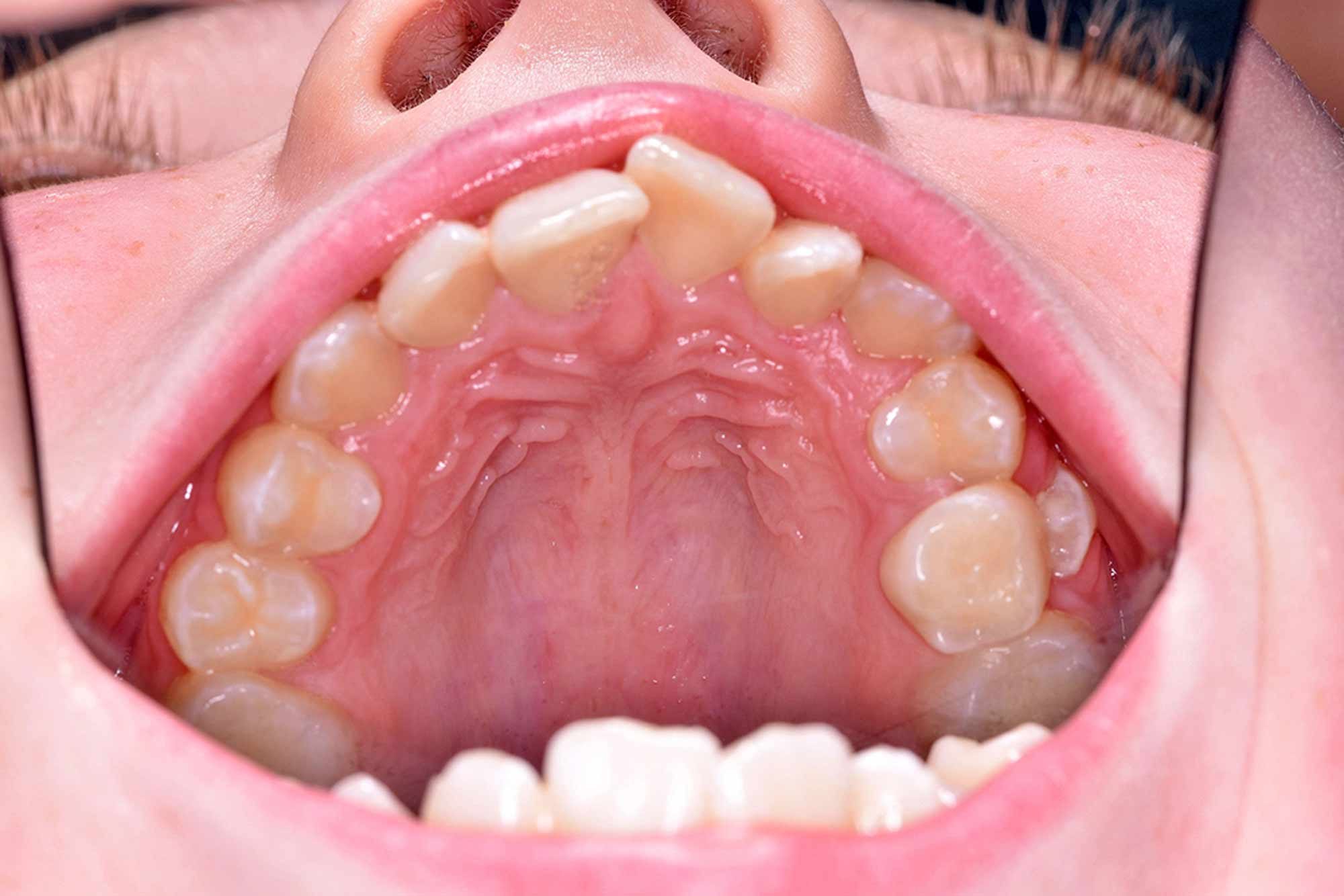 Fig-5-Maxillary-occlusal---before