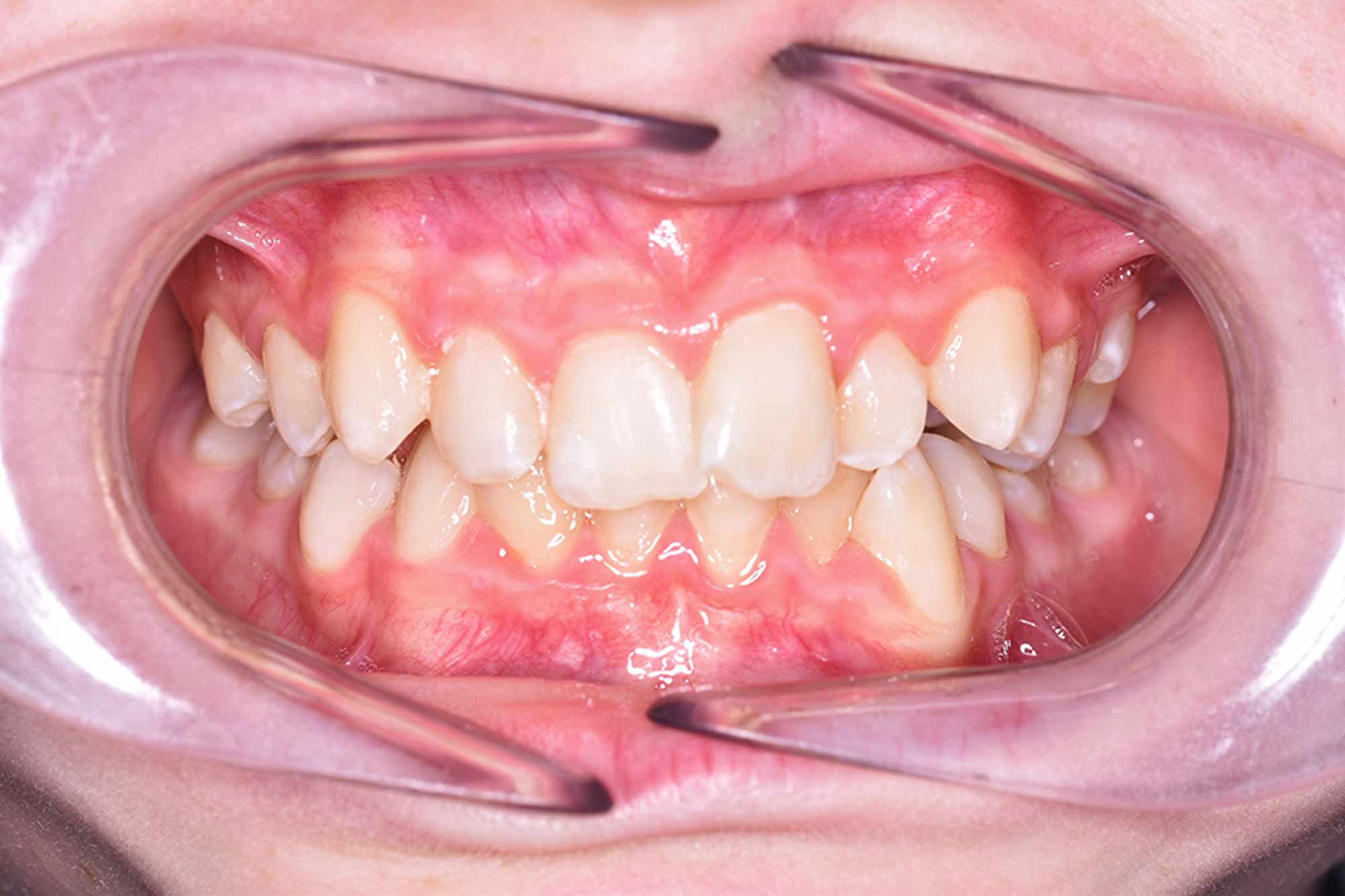 Fig-6-Occlusal---before