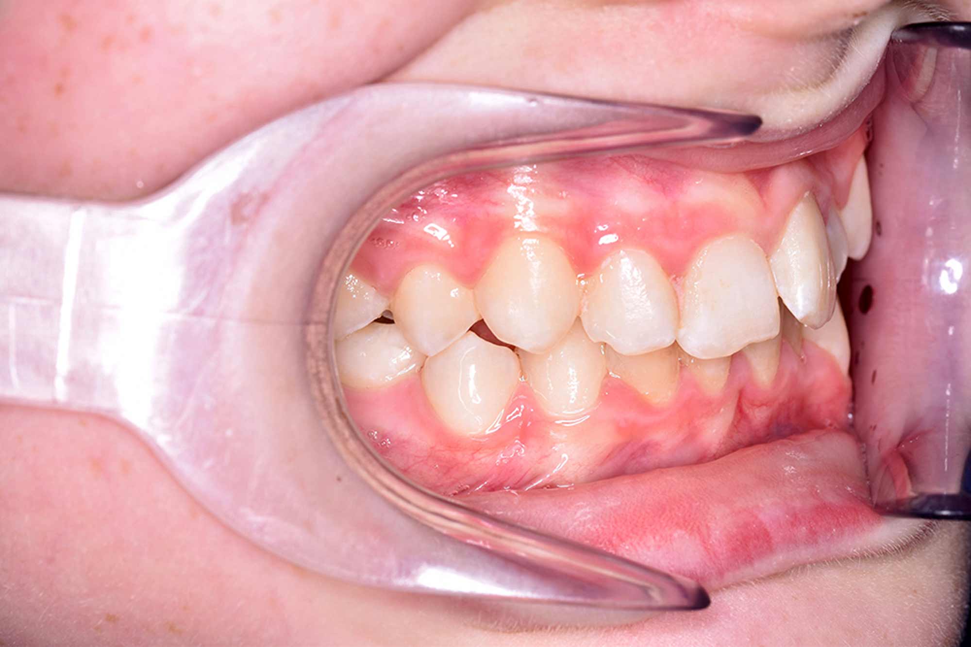 Fig-7-Right-Buccal---before