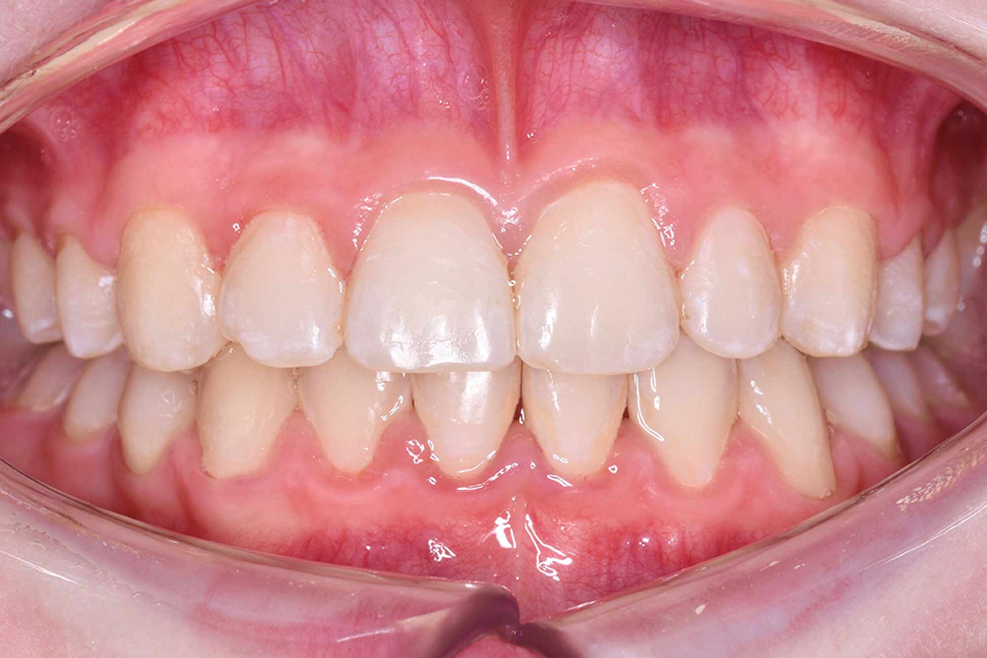 Fig-8-anterior---after