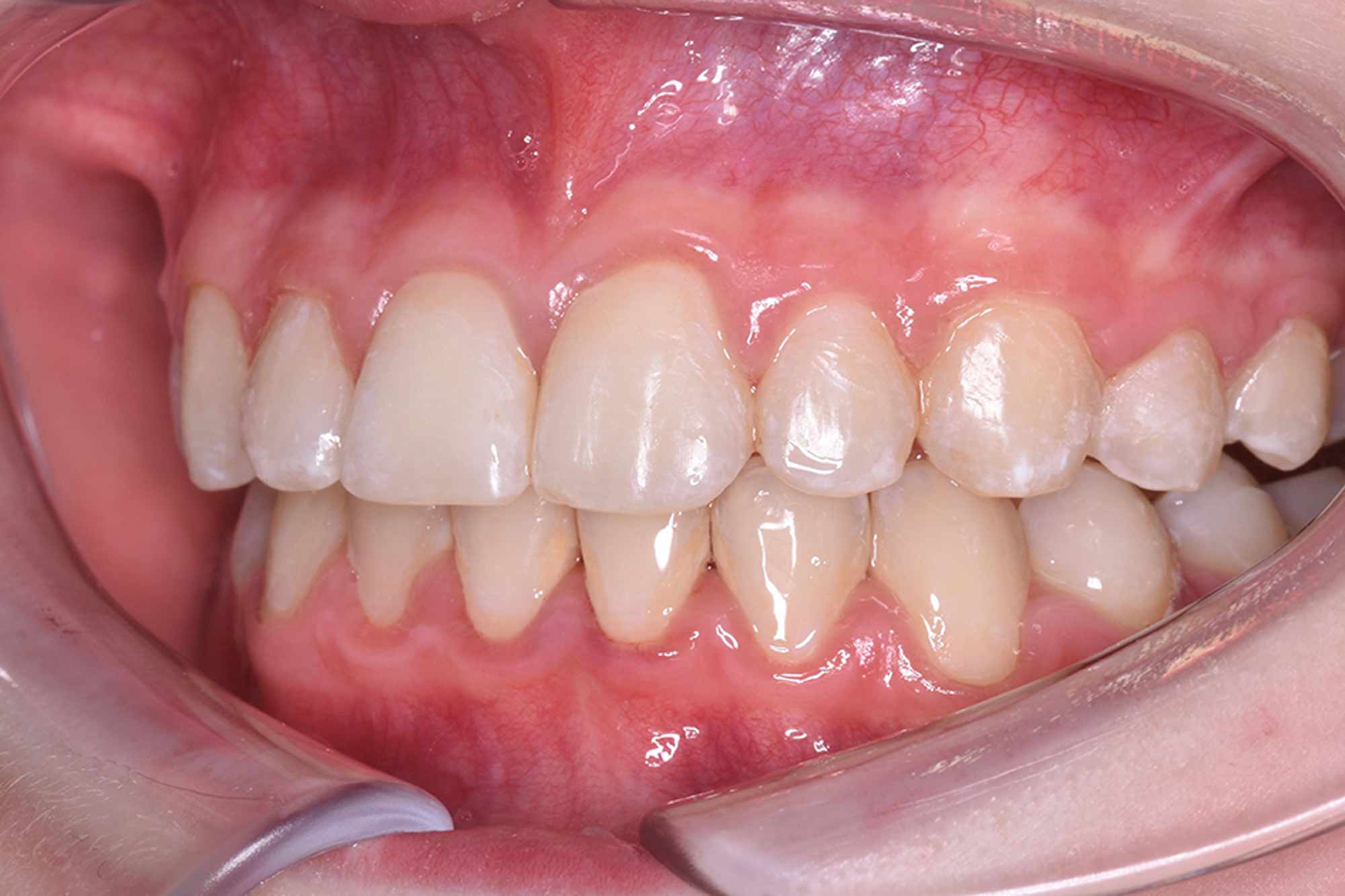 Fig-9-Left-Buccal---after
