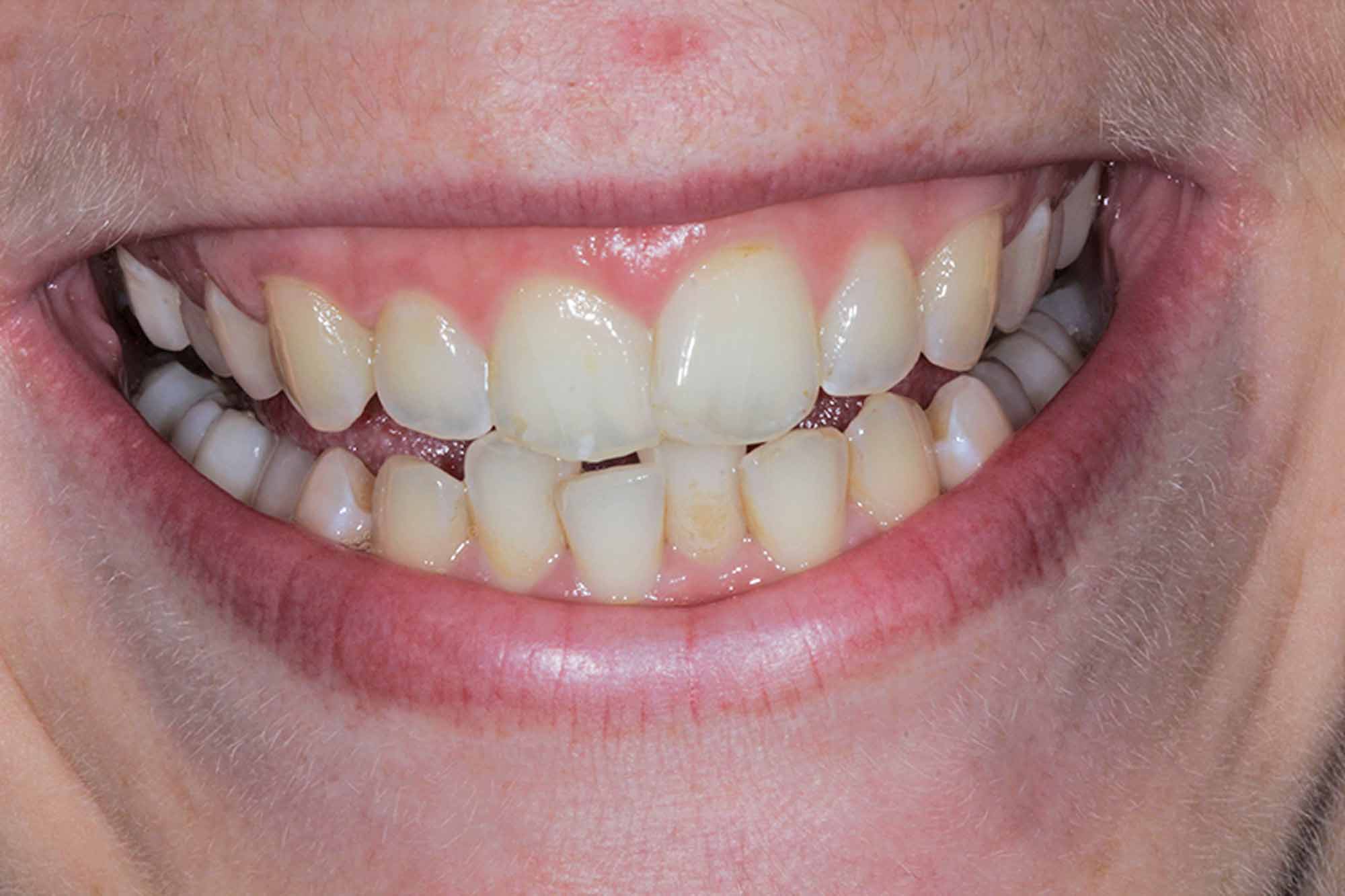 Figure-1-Front-Smile---Pre-treatment