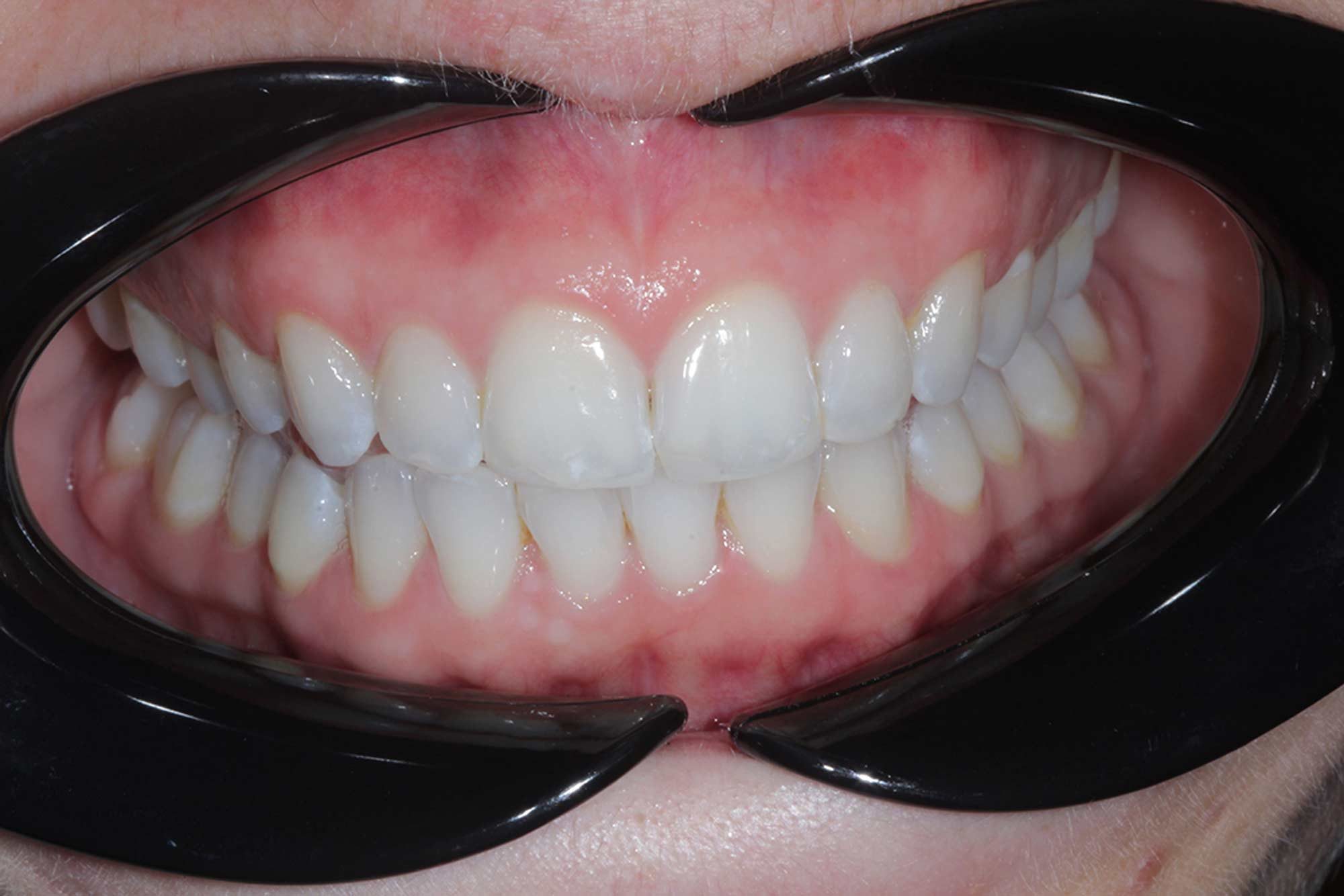 Figure-10-Front-Gums---Post-Invisalign,-Whitening-&-Bonding