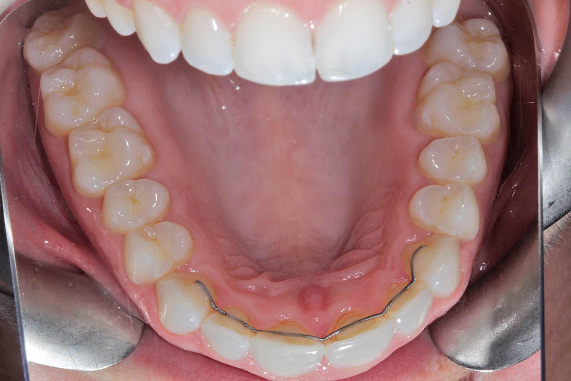 Figure-12-Upper-Jaw---Post-Invisalign,-Whitening-&-Bonding