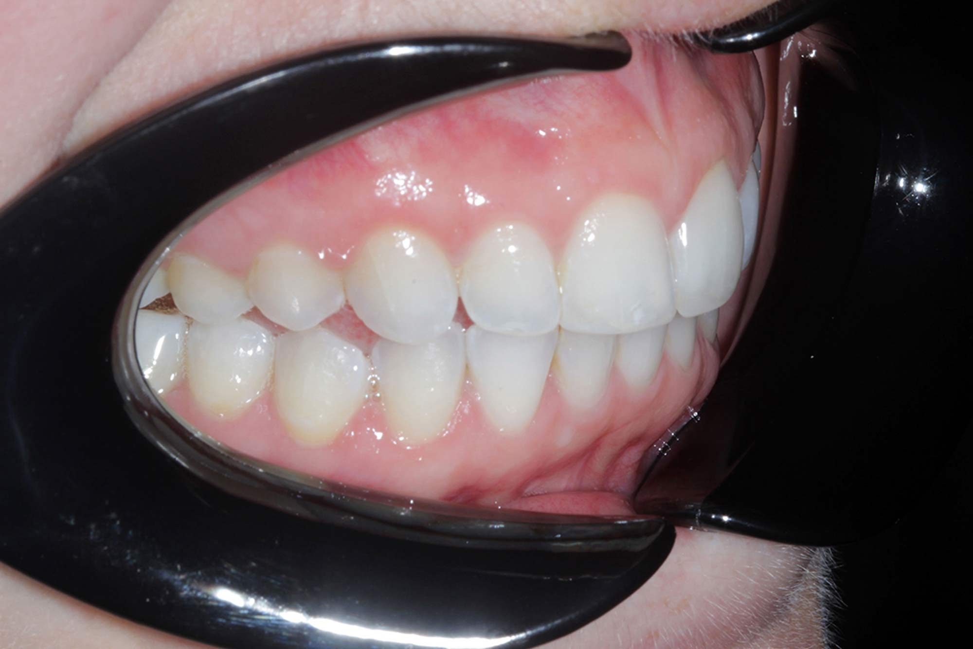 Figure-13-Right-Side-Gums---Post-Invisalign,-Whitening-&-Bonding