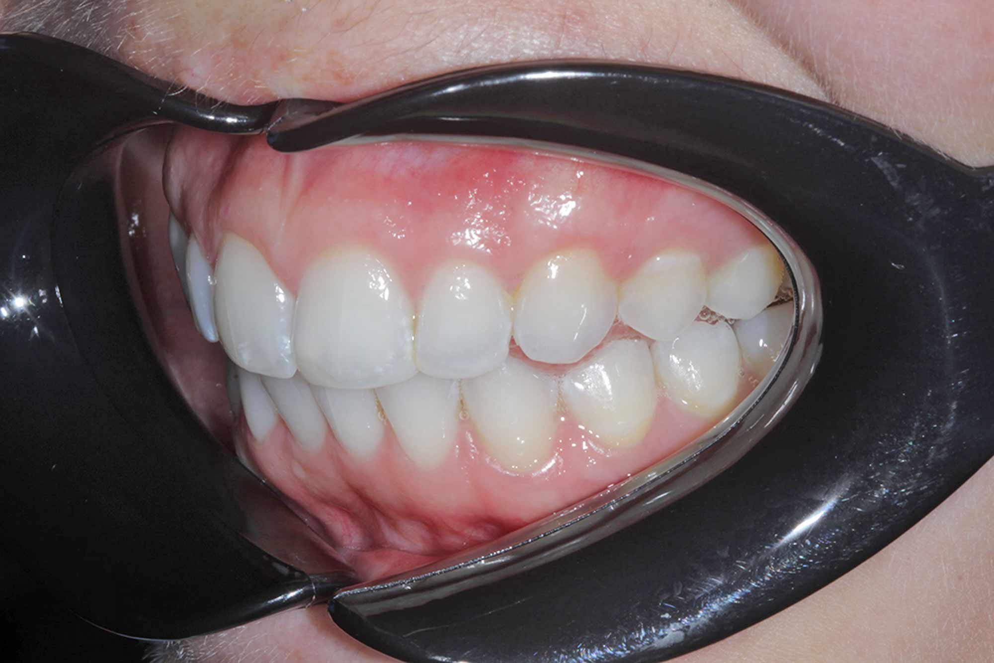 Figure-14-Left-Side-Gums---Post-Invisalign,-Whitening-&-Bonding