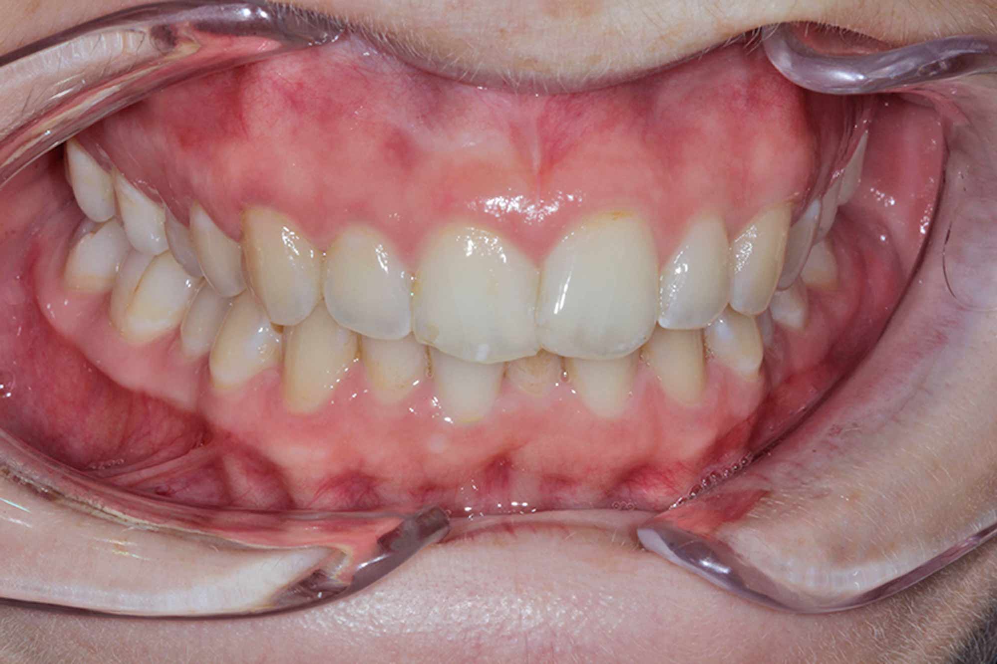 Figure-2-Front-Gums---Pre-treatment