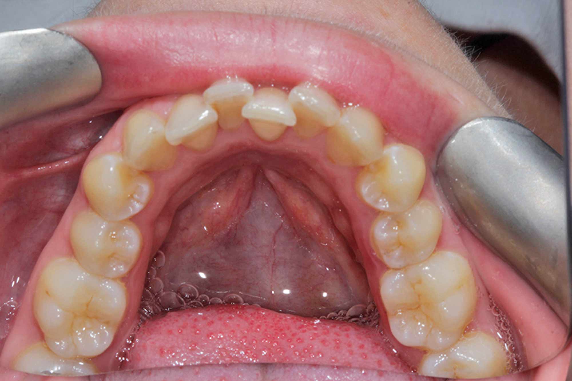 Figure-3-Lower-Jaw---Pre-treatment