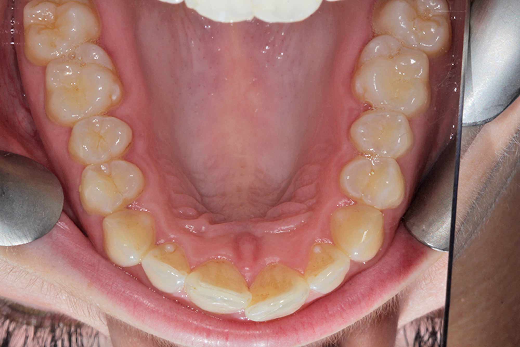 Figure-4-Upper-Jaw---Pre-treatment