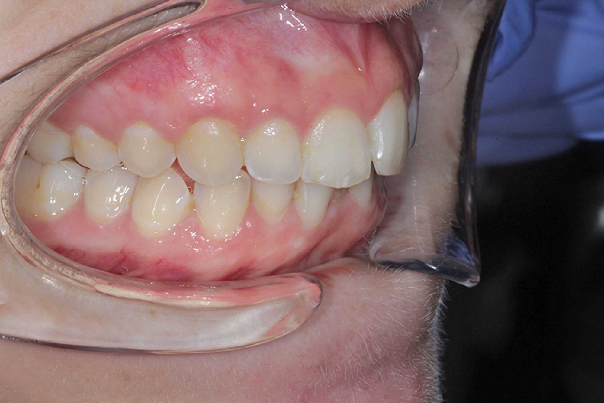 Figure-5-Right-Side-Gums---Pre-treatment