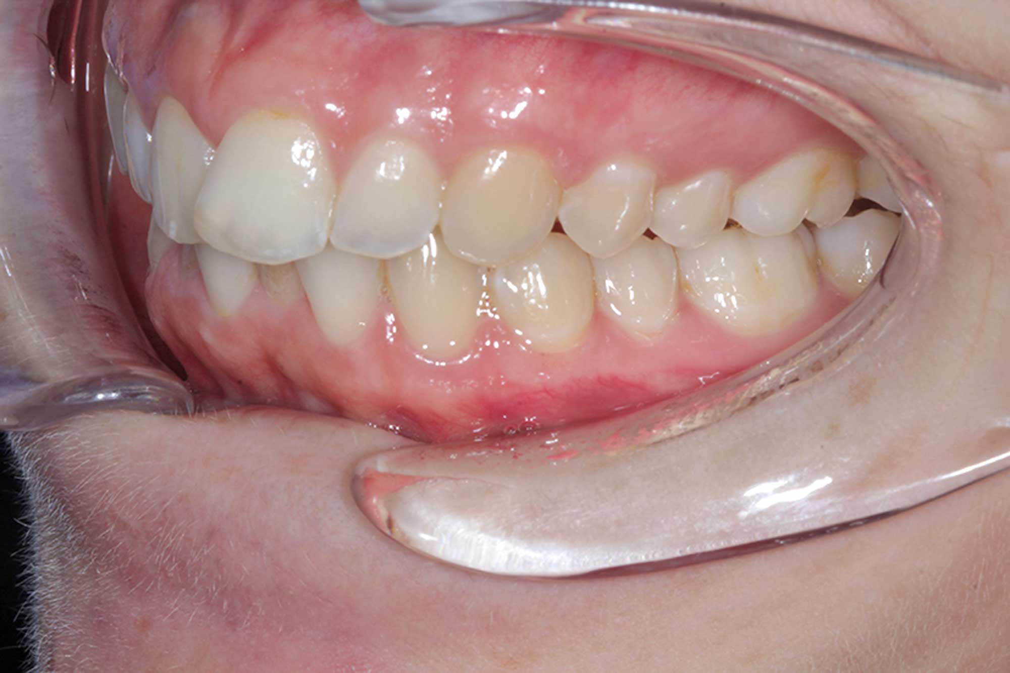 Figure-6-Left-Side-Gums---Pre-treatment
