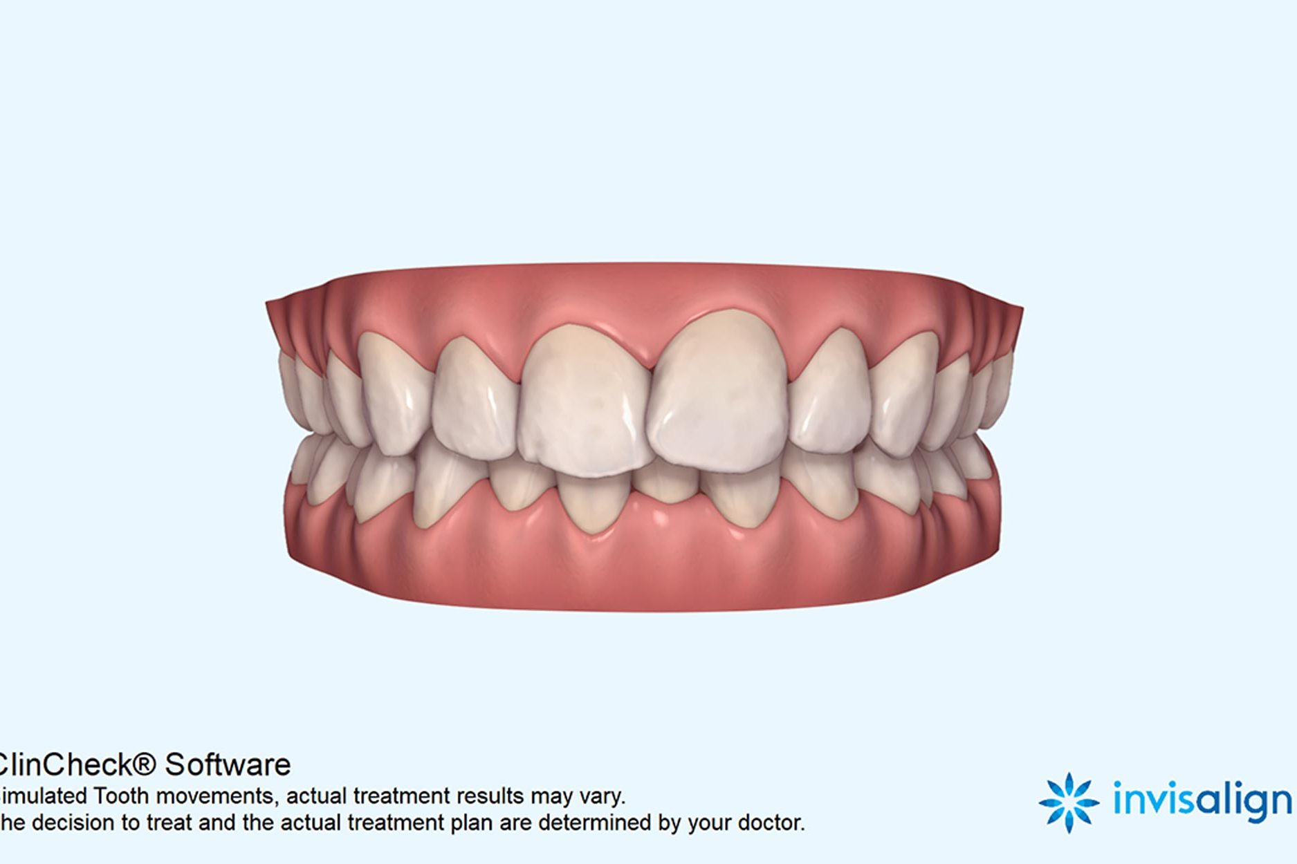 Figure-7a-Clincheck-before