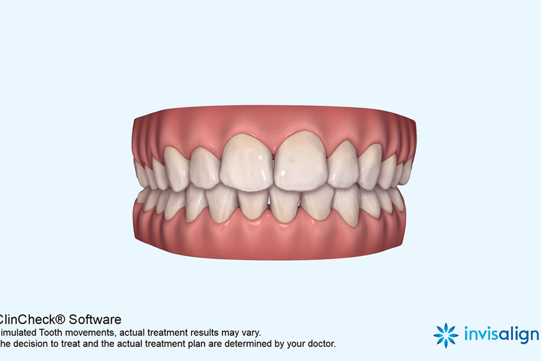 Figure-7b-Clincheck-after