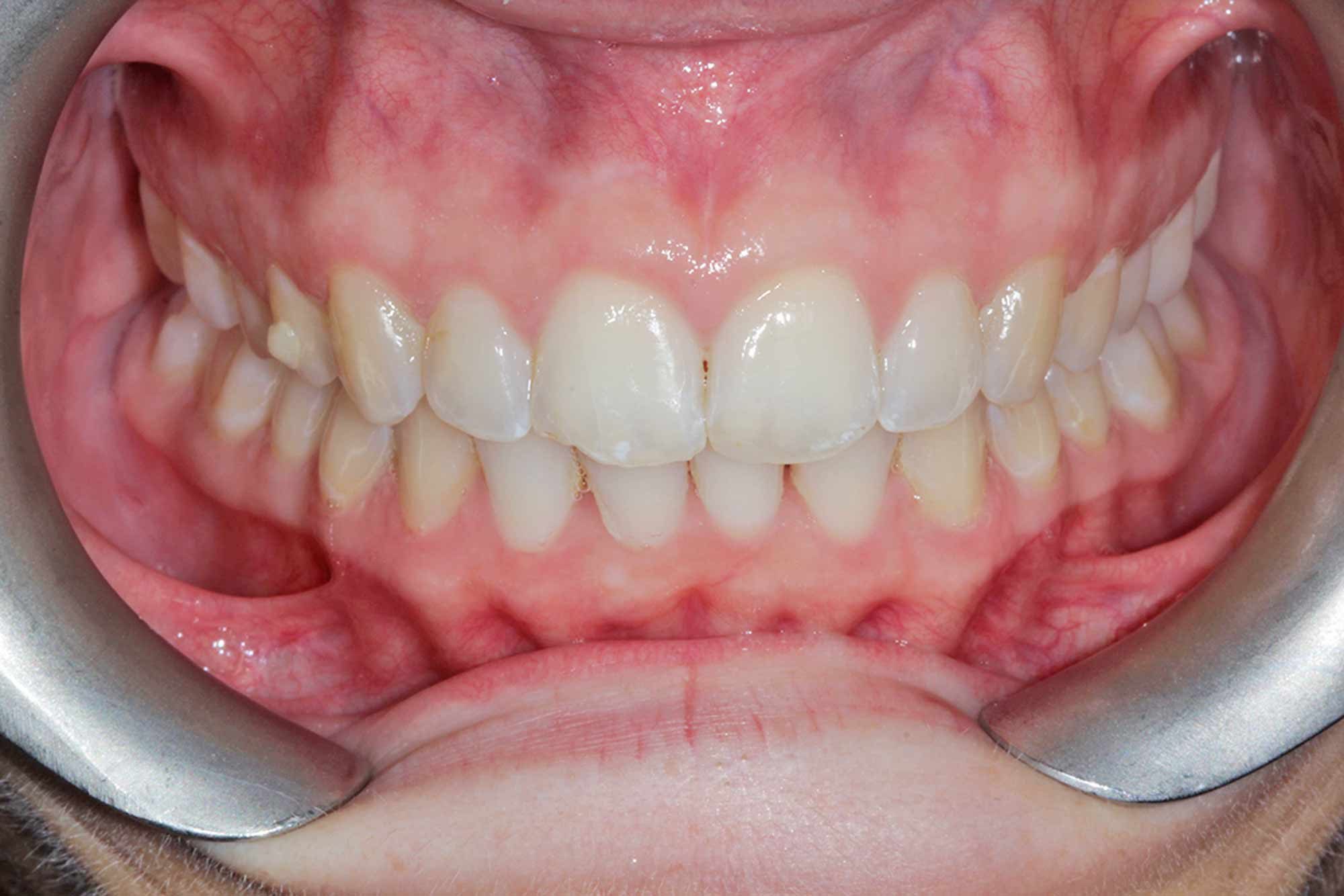Figure-8-Front-Gums---Post-Invisalign