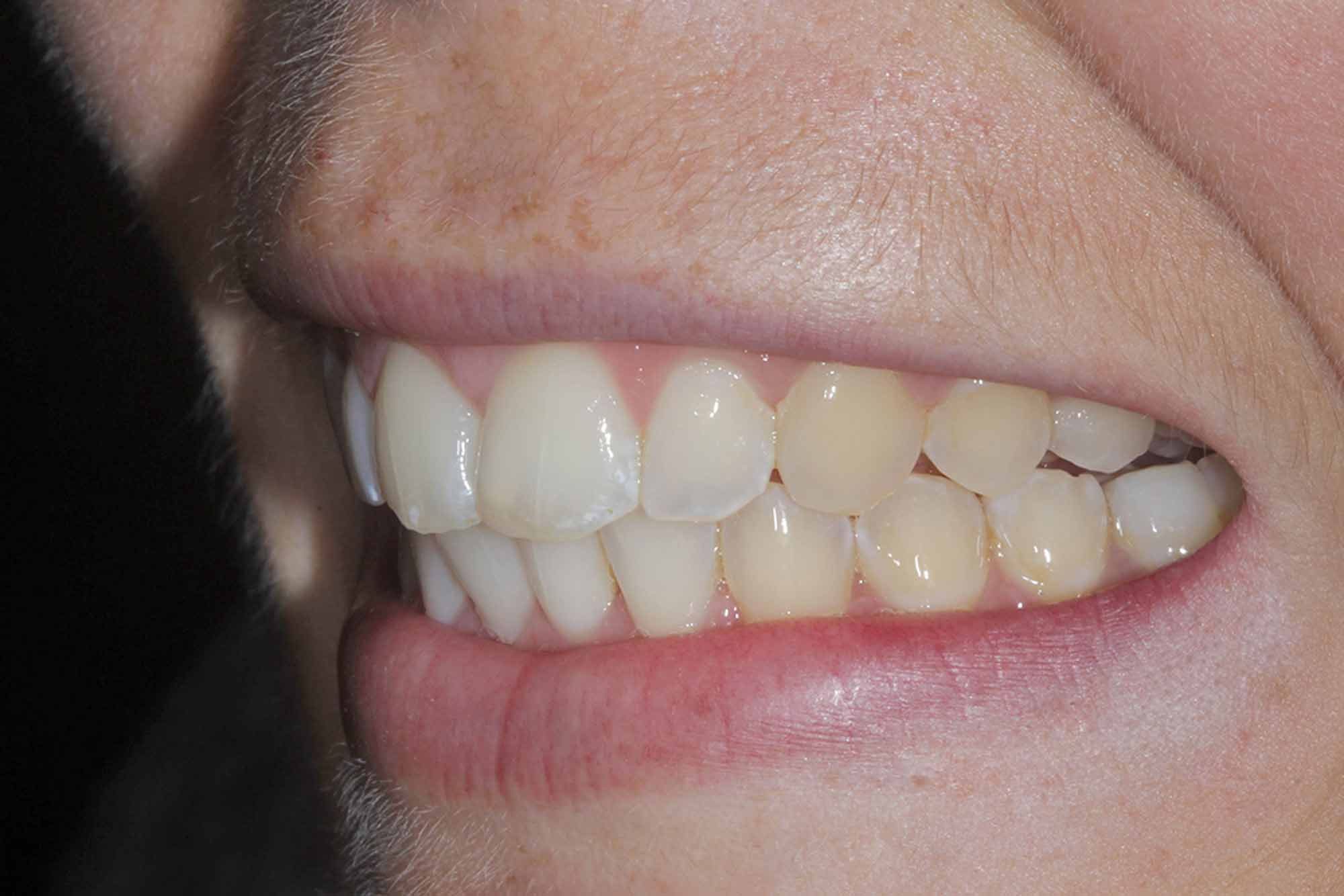 Figure-9-Left-Side-Smile---Post-Invisalign-&-Pre-Bonding