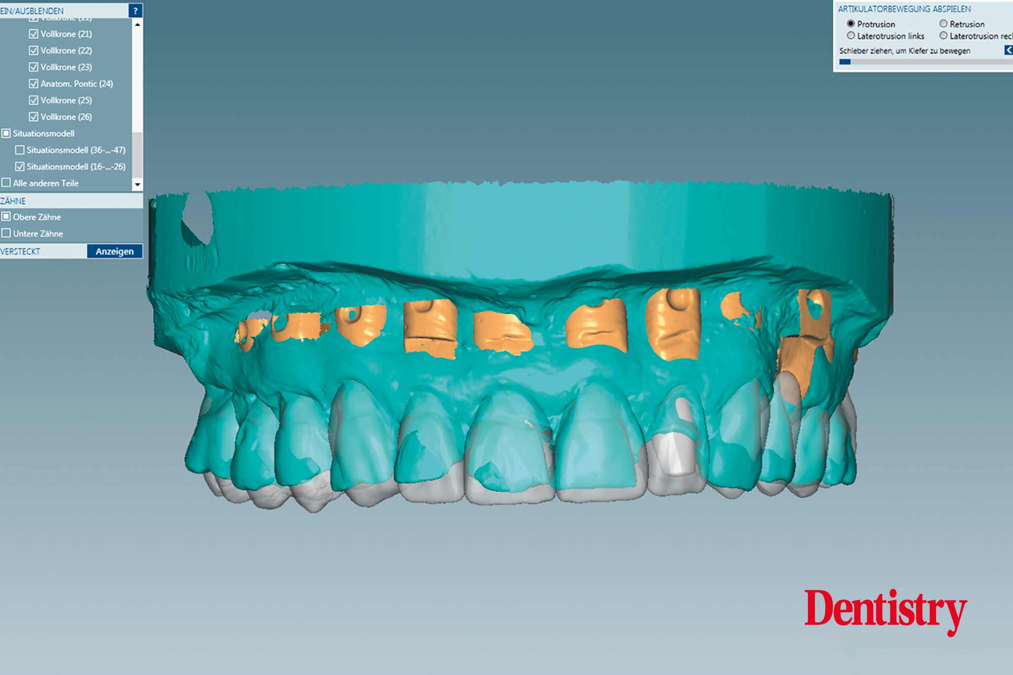 3b Fabrication and cementation of crowns without chipping
