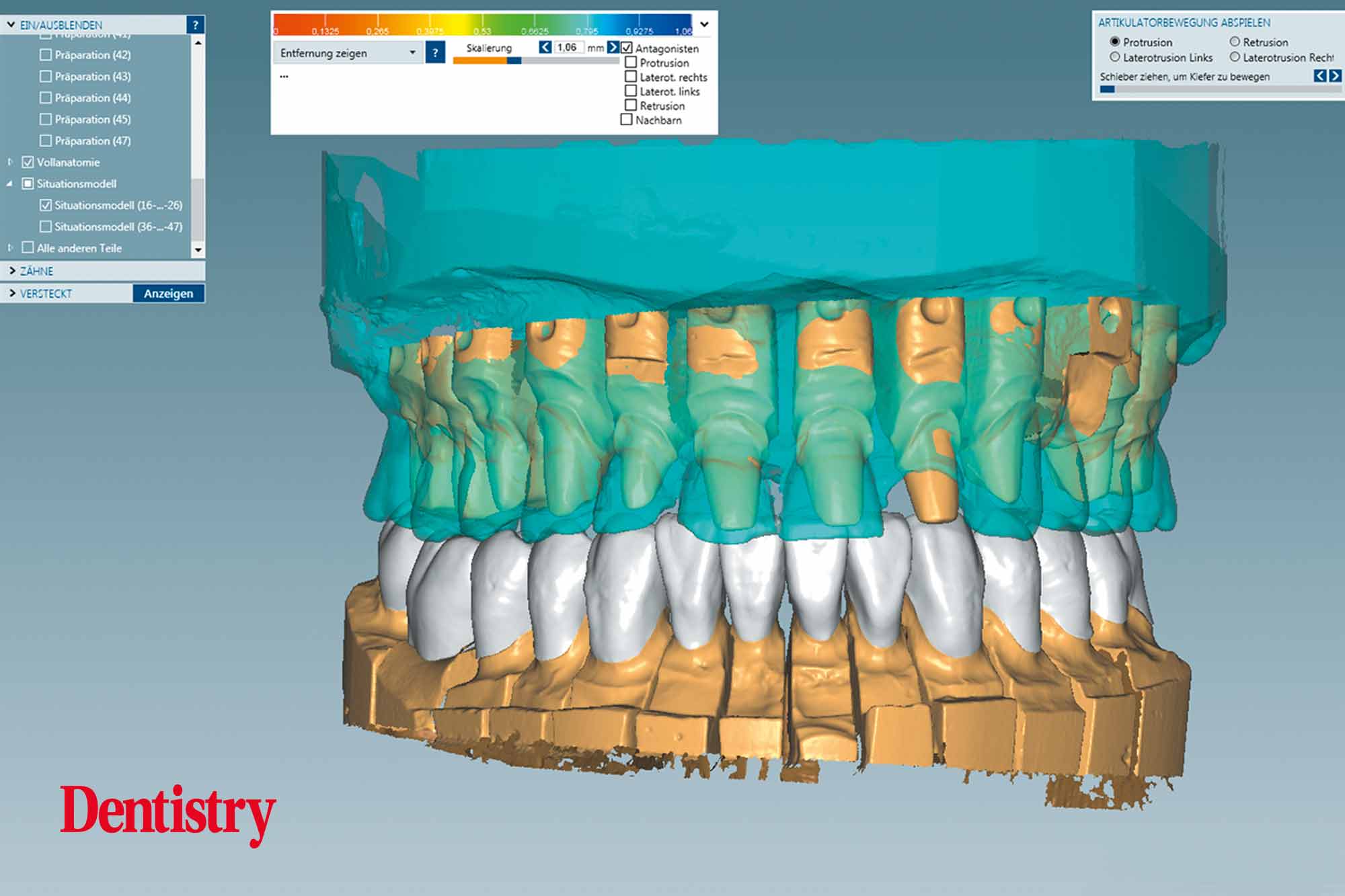 3d Fabrication and cementation of crowns without chipping