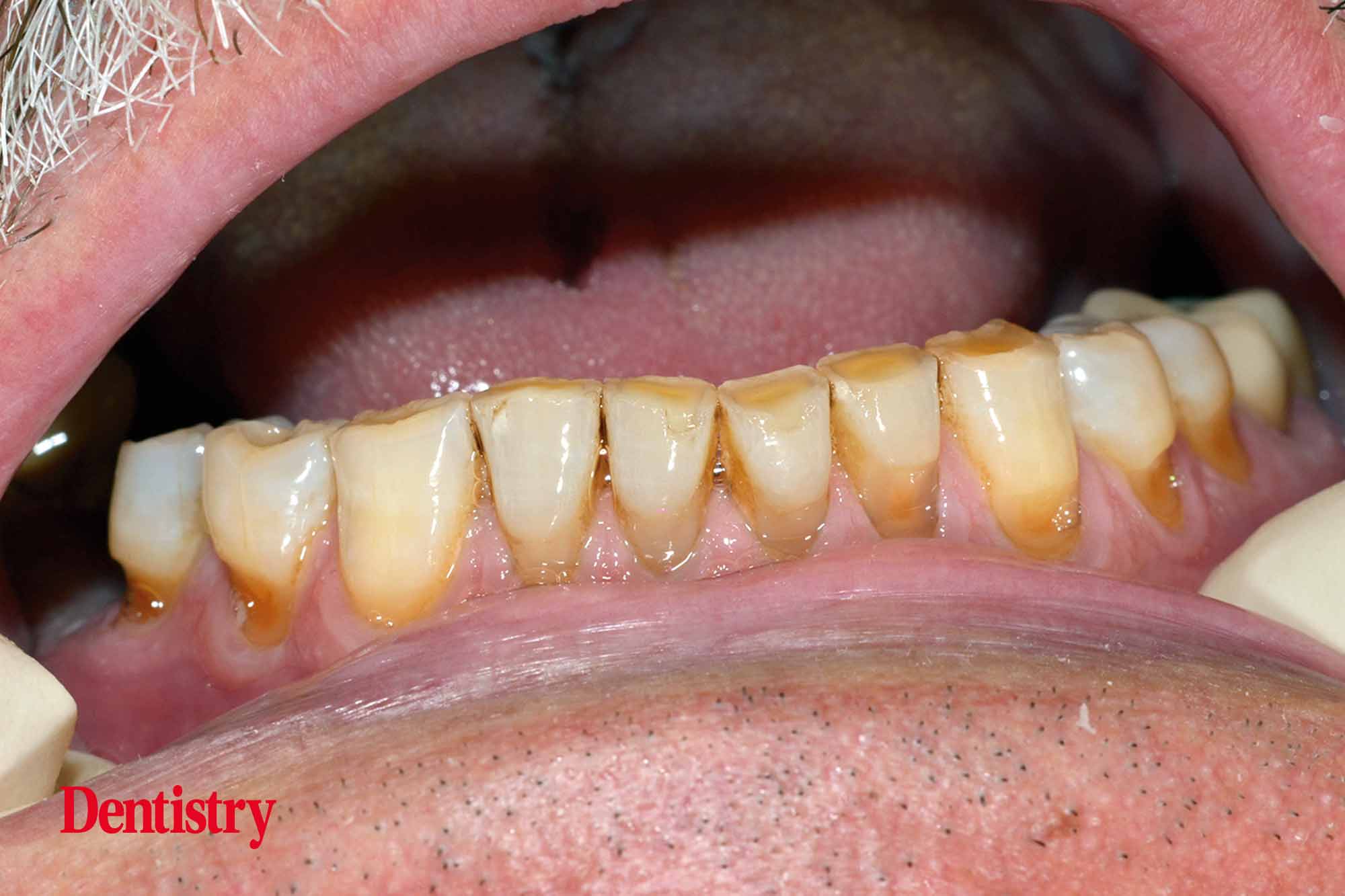 1a Fabrication and cementation of crowns without chipping