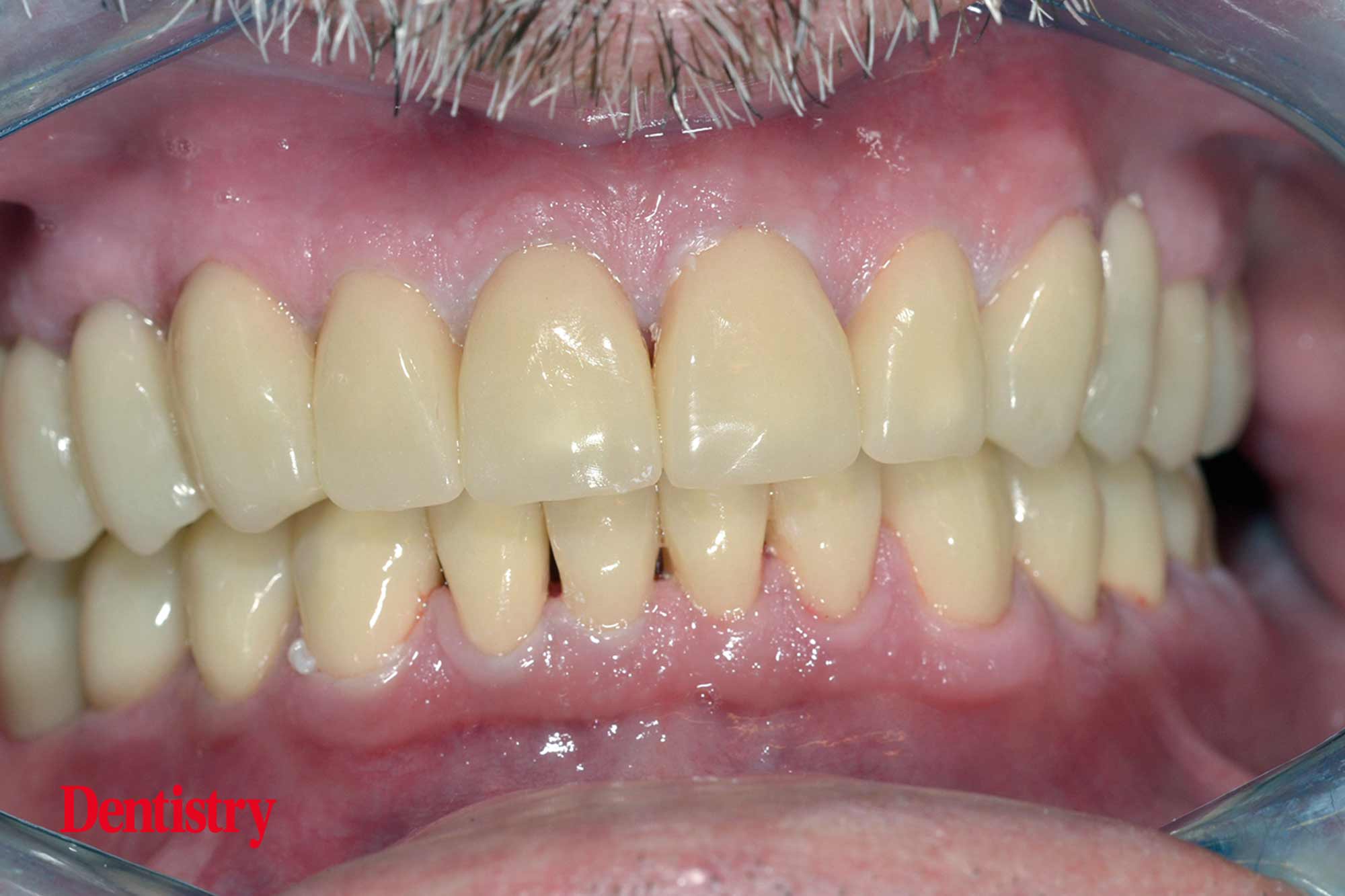 10 Fabrication and cementation of crowns without chipping