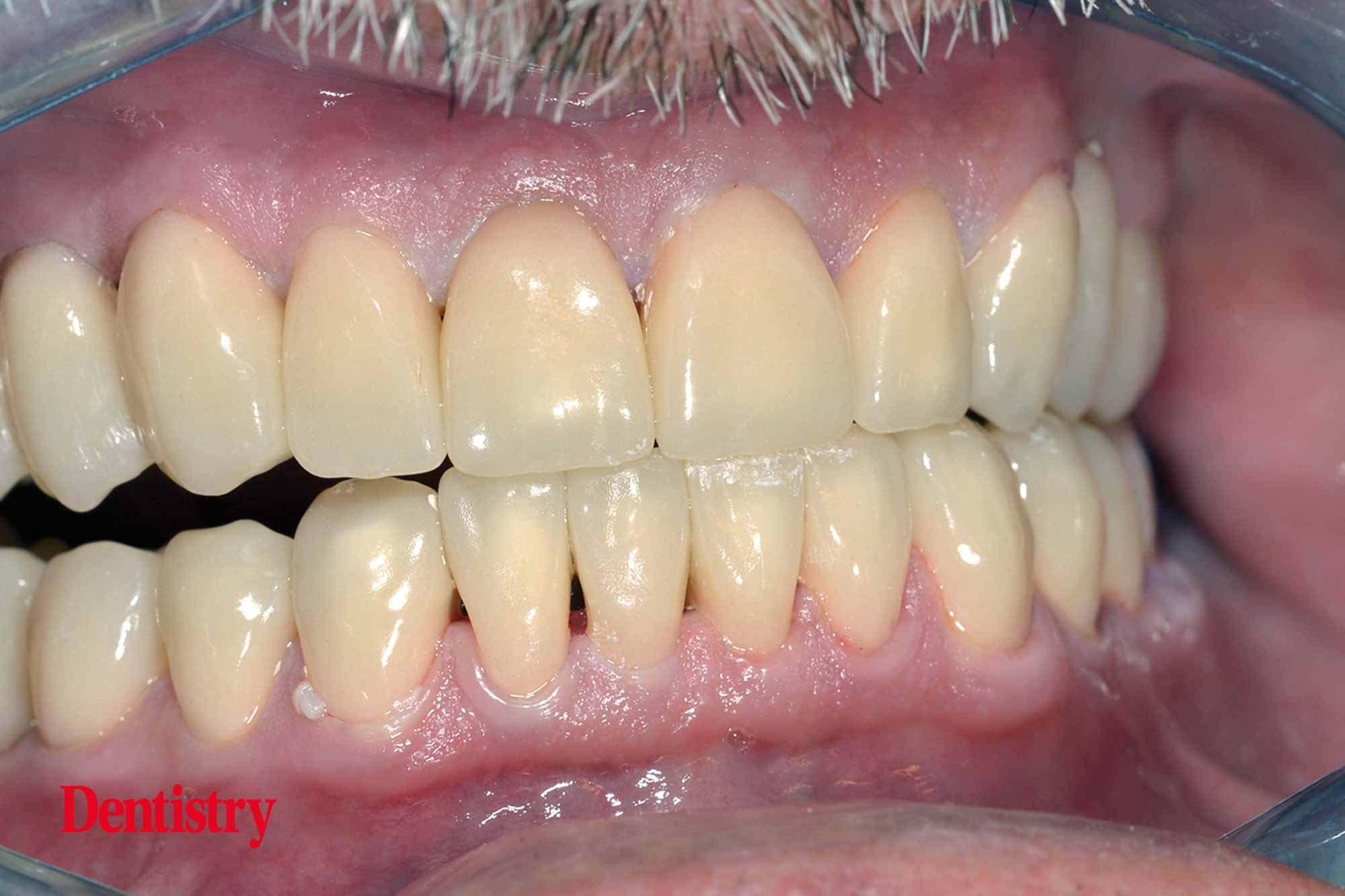 11 Fabrication and cementation of crowns without chipping