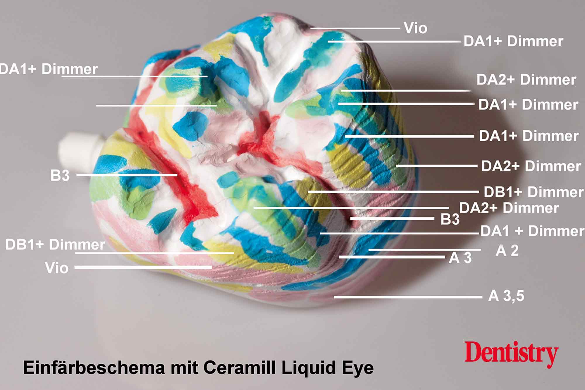 fig-15 Fabrication and cementation of crowns without chipping
