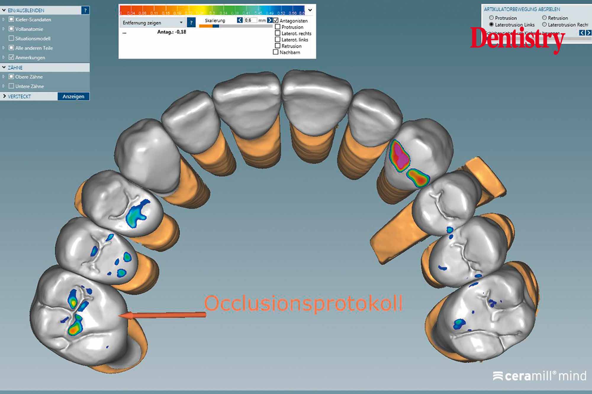 fig-19 Fabrication and cementation of crowns without chipping