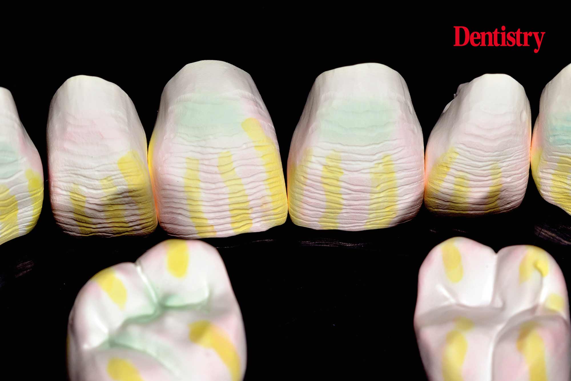 fig-21 Fabrication and cementation of crowns without chipping
