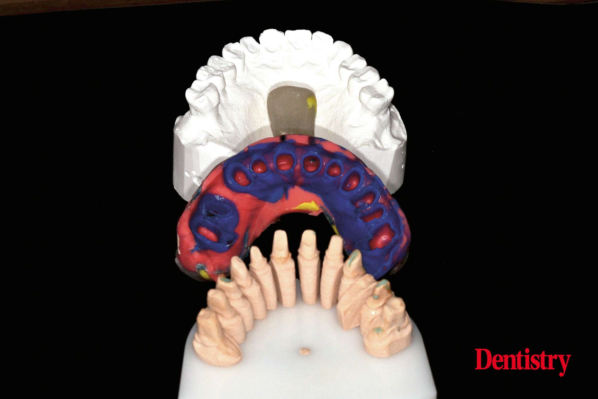 2b Fabrication and cementation of crowns without chipping