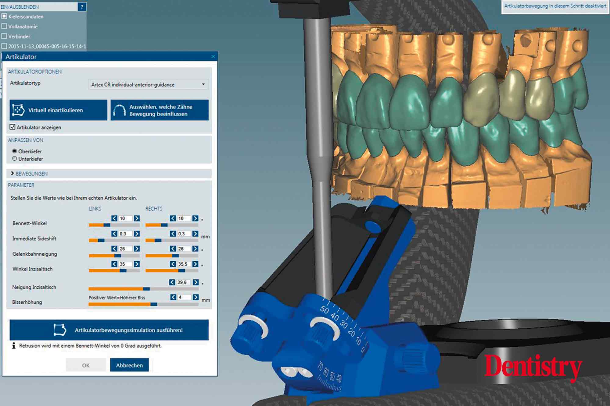 4 Fabrication and cementation of crowns without chipping