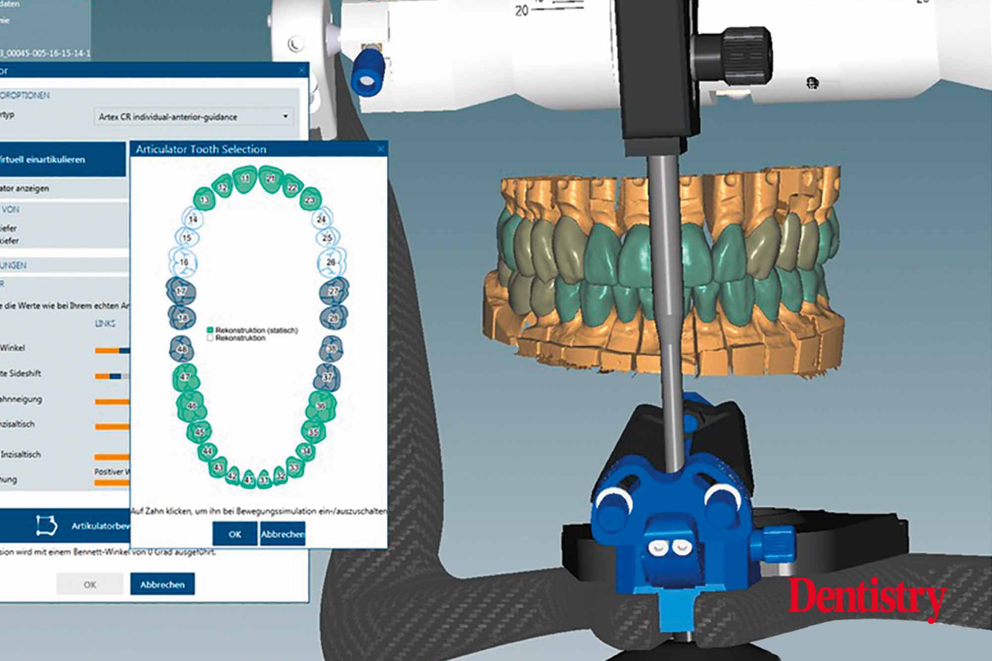 5 Fabrication and cementation of crowns without chipping