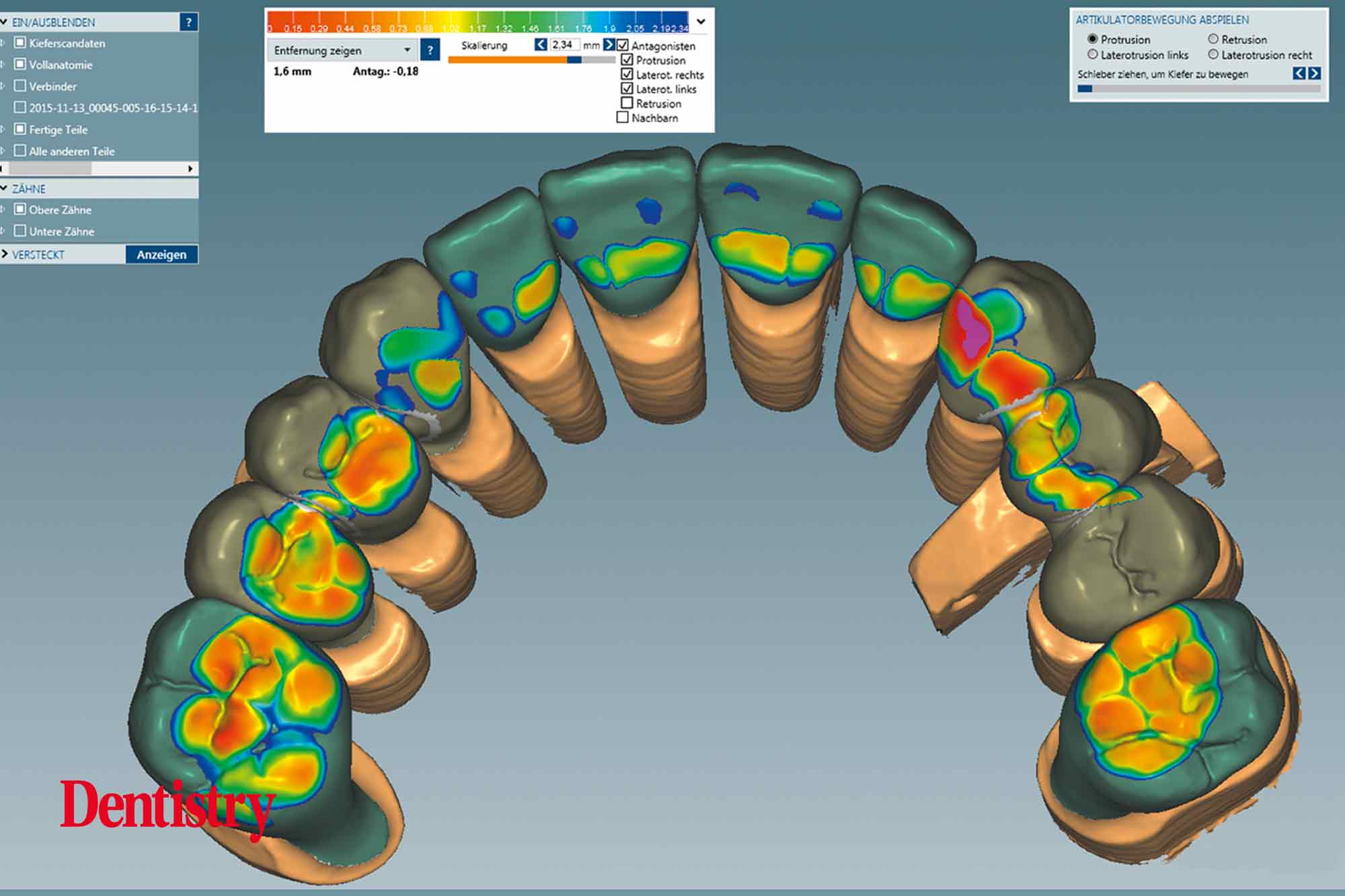 6 Fabrication and cementation of crowns without chipping