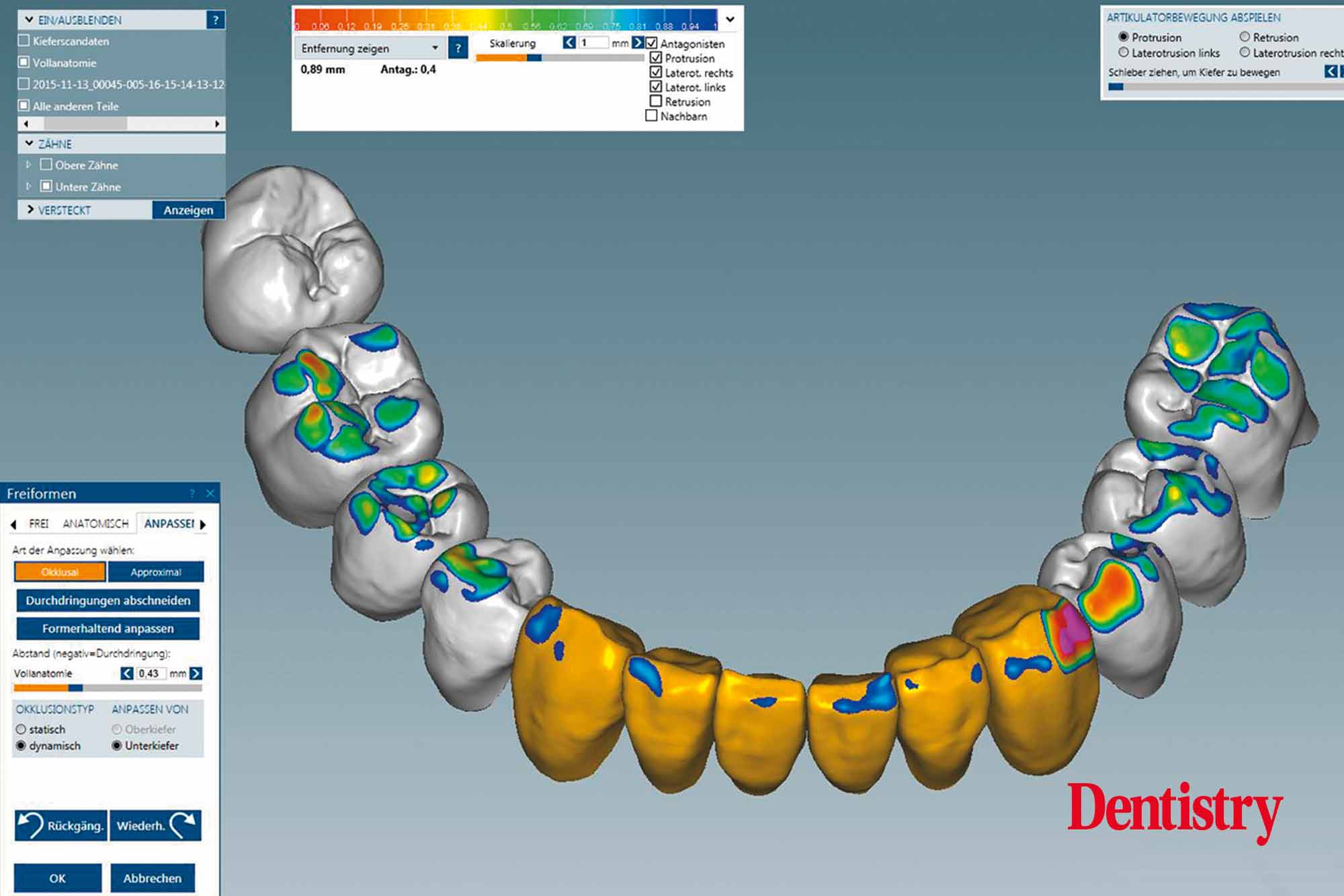 7 Fabrication and cementation of crowns without chipping
