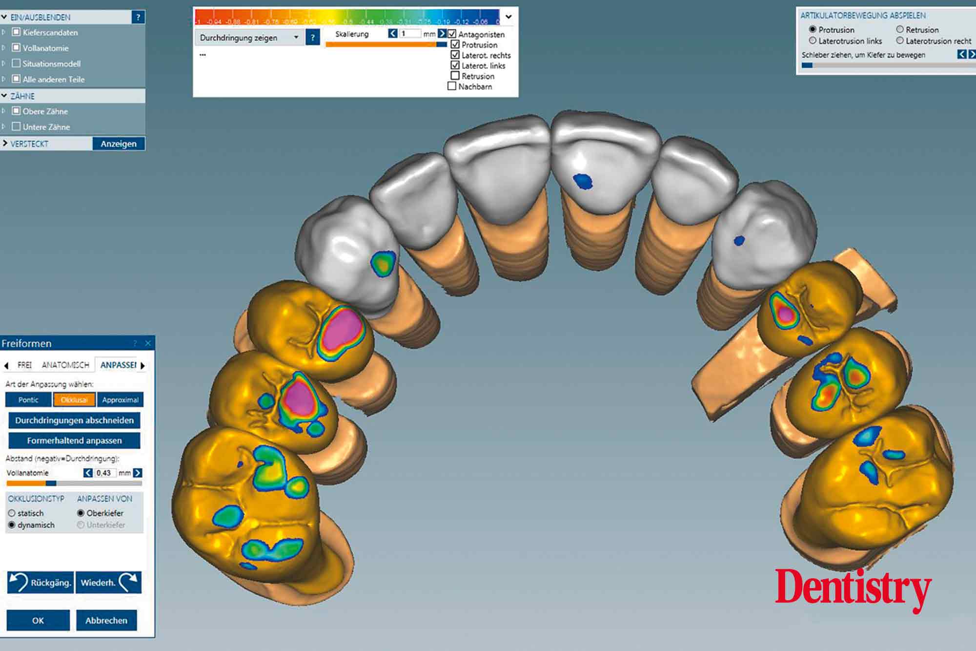 8 Fabrication and cementation of crowns without chipping